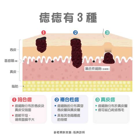 容易長痣|痣變大、痣多或長毛會變皮膚癌？認識痣的形成與原因